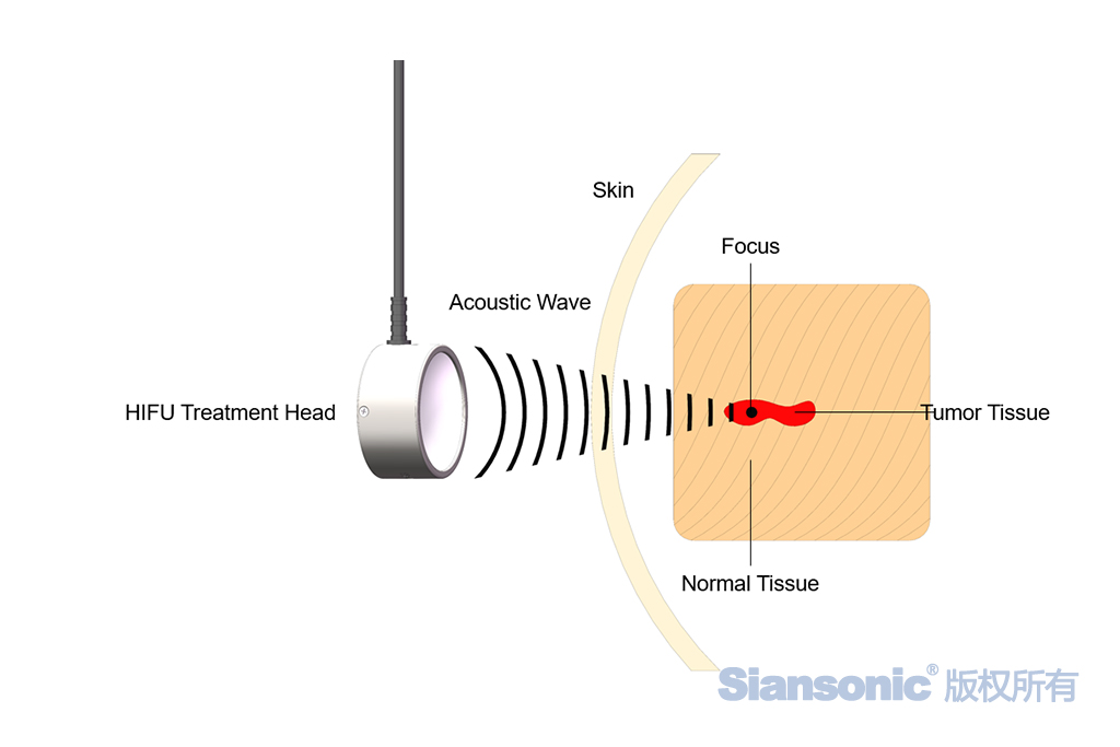 principle of  tumor treatment used by focused ultrasound